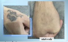 DR. TATTOF ผู้นำในการรักษาด้วยนวัตกรรมเซอร์ ด้วยโปรแกรม PICOWAY LASER